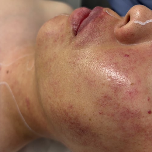 単純性血管腫(Vビーム治療前) 