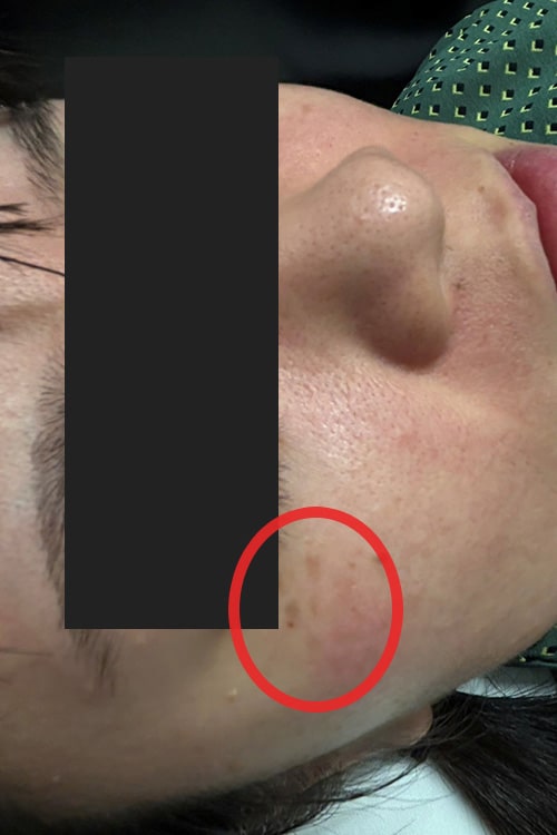 ADM(後天性真皮メラノサイトーシス)写真